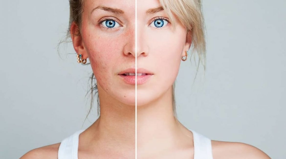 rosacea
